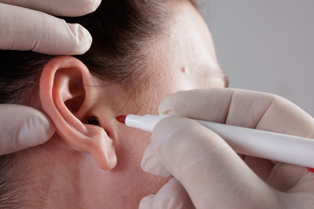 Qué es la otoplastia
