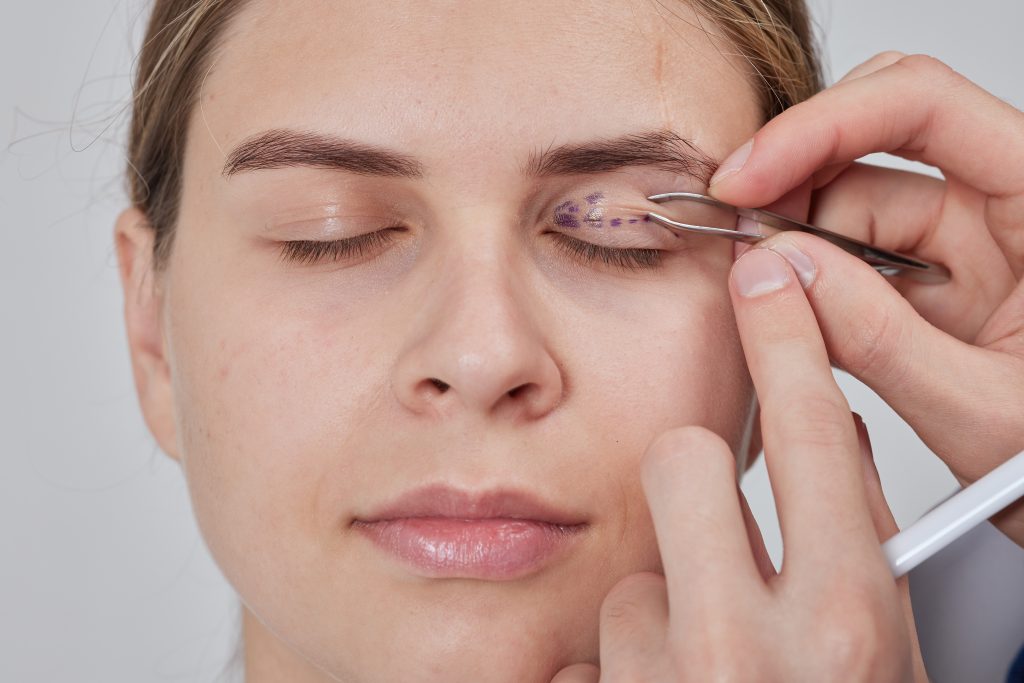 Se puede retocar una blefaroplastia