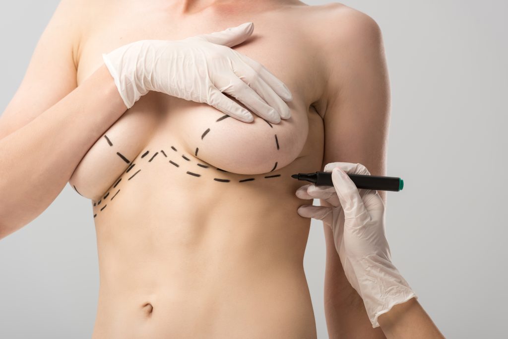 Qué es una mamoplastia