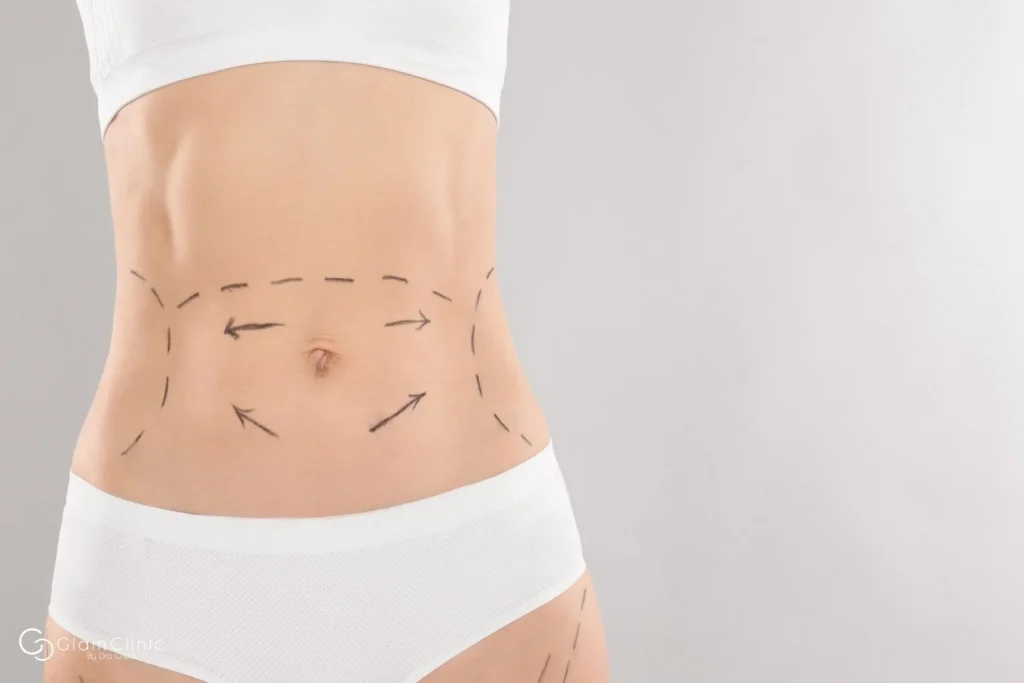 Médico realizando exploración clínica de diástasis de rectos en paciente en decúbito supino en consulta de cirugía estética Madrid