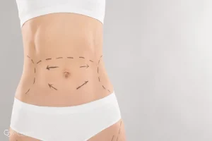 Médico realizando exploración clínica de diástasis de rectos en paciente en decúbito supino en consulta de cirugía estética Madrid